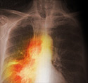bronchitis